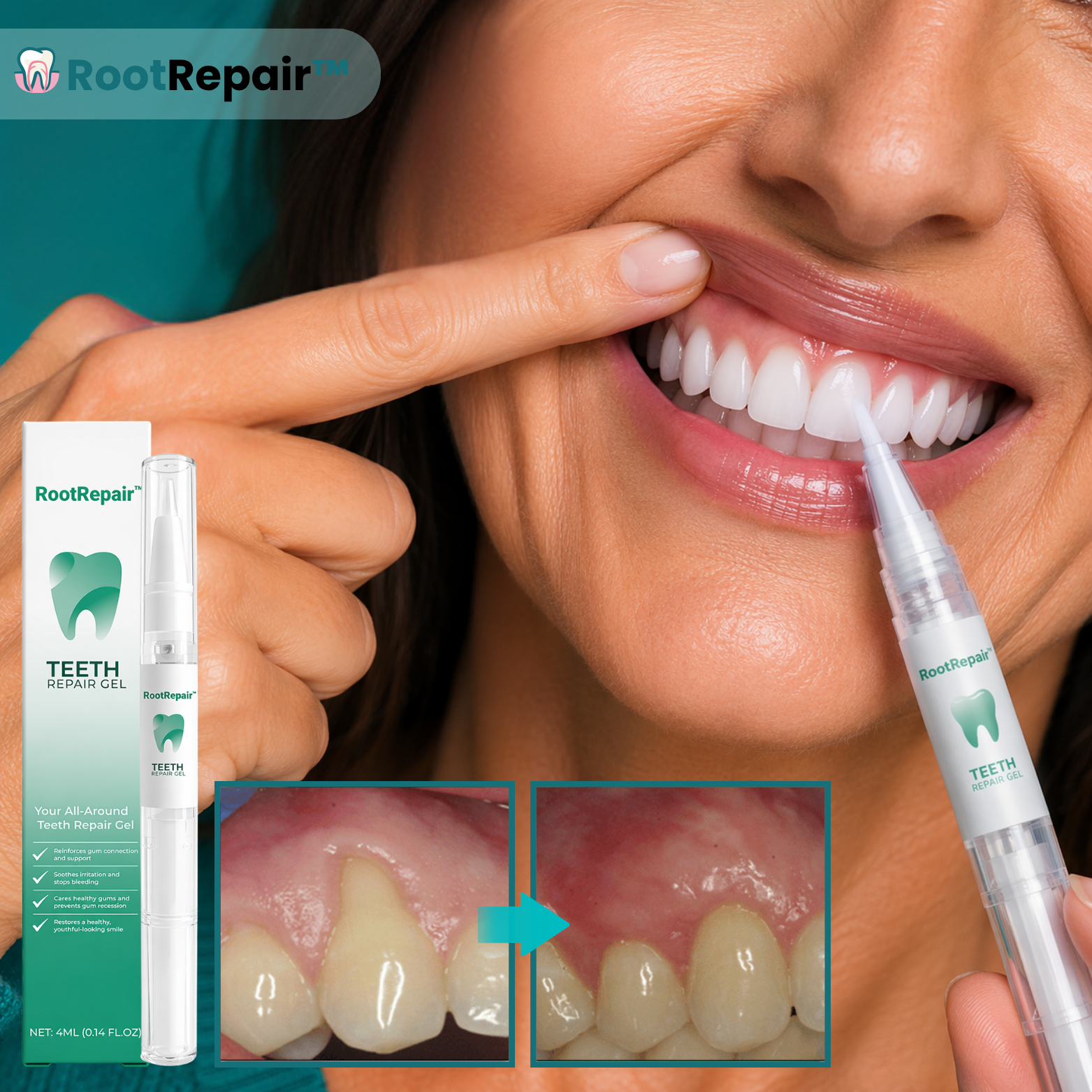 RootRepair™ Gel réparateur pour les dents