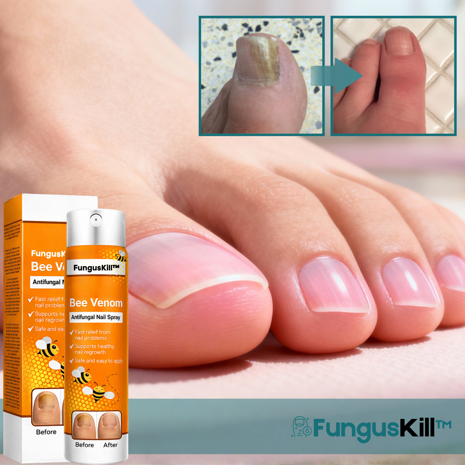 FungusKill™ Spray Antifongique pour les Ongles (Higher Offer)