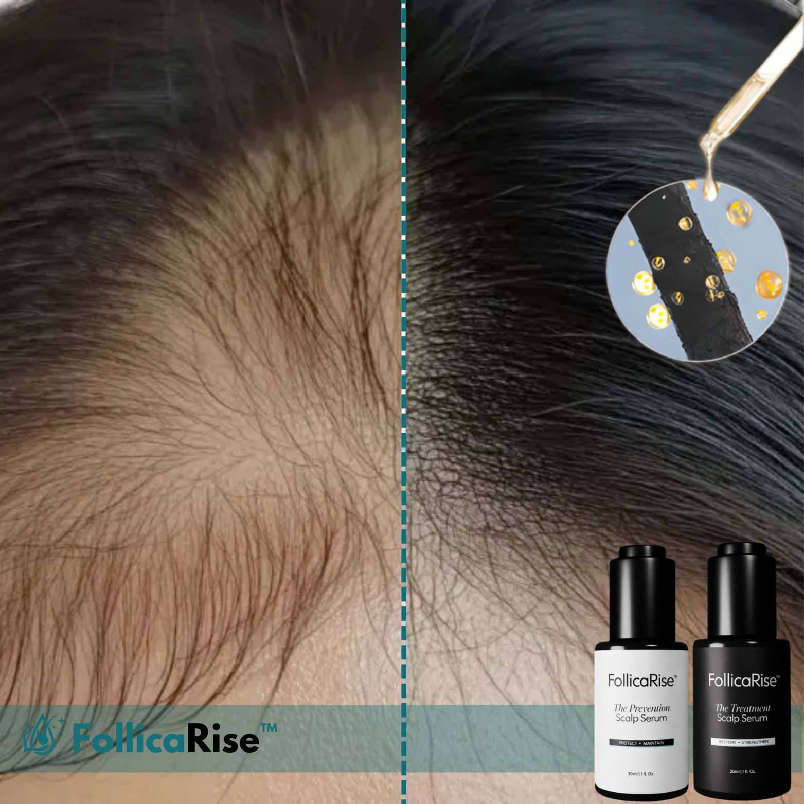 FollicaRise™ Sérum capillaire pour la croissance des cheveux